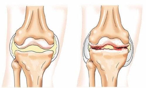 articulation du genou saine et arthrosique